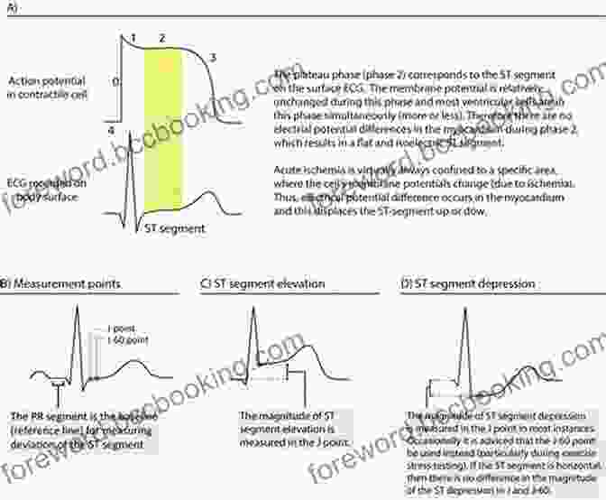 Evaluating ST Segment And T Wave Changes EKG/ECG Interpretation: A Complete Step By Step Beginner S Guide To A Rapid Interpretation Of The 12 Lead EKG And On How To Diagnose And Treat Arrhythmias