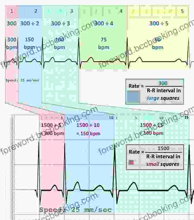 Heart Rate And Rhythm Analysis EKG/ECG Interpretation: A Complete Step By Step Beginner S Guide To A Rapid Interpretation Of The 12 Lead EKG And On How To Diagnose And Treat Arrhythmias